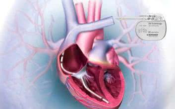 Aktywne implanty okiem inżyniera medycznego