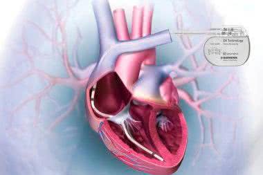 Aktywne implanty okiem inżyniera medycznego